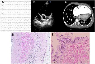 Whole-Exome Sequencing Identifies a Novel Variant (c.1538T > C) of TNNI3K in Arrhythmogenic Right Ventricular Cardiomyopathy